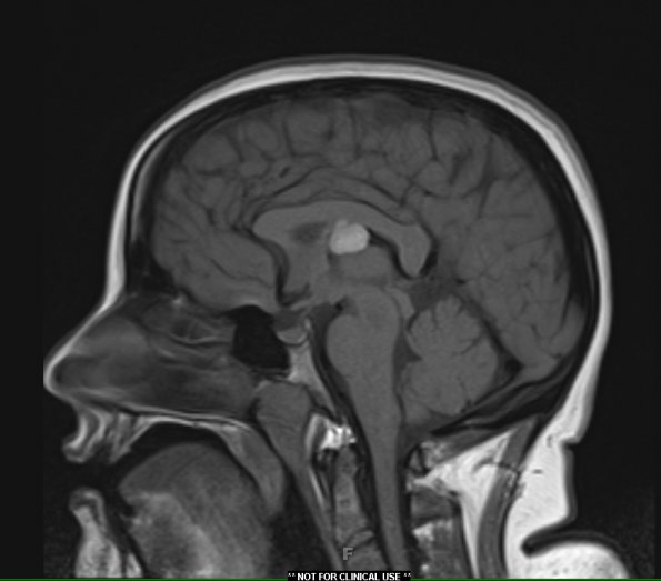 1A2 Cyst, colloid (Case 1) T1