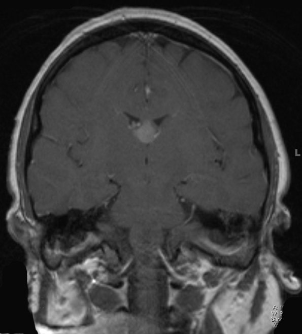 1A3 Cyst, colloid (Case 1) T1 W 2