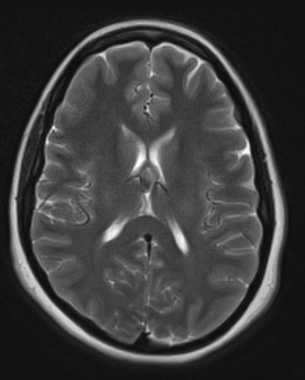 1A4 Cyst, colloid (Case 1) T2 W