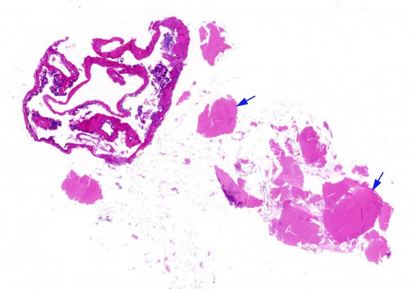 1B1 Cyst, colloid (Case 1) H&E whole mount