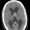 2A1 Cyst, colloid (Case 2) CT