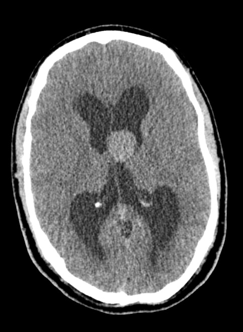 2A1 Cyst, colloid (Case 2) CT