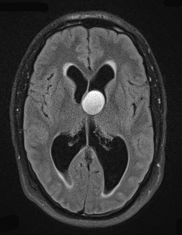 2A2 Cyst, colloid (Case 2) FLAIR BLADE