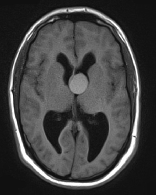 2A3 Cyst, colloid (Case 2) T1 BLADE