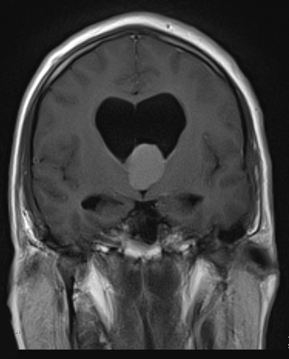 2A5 Cyst, colloid (Case 2) T1 BLADE W