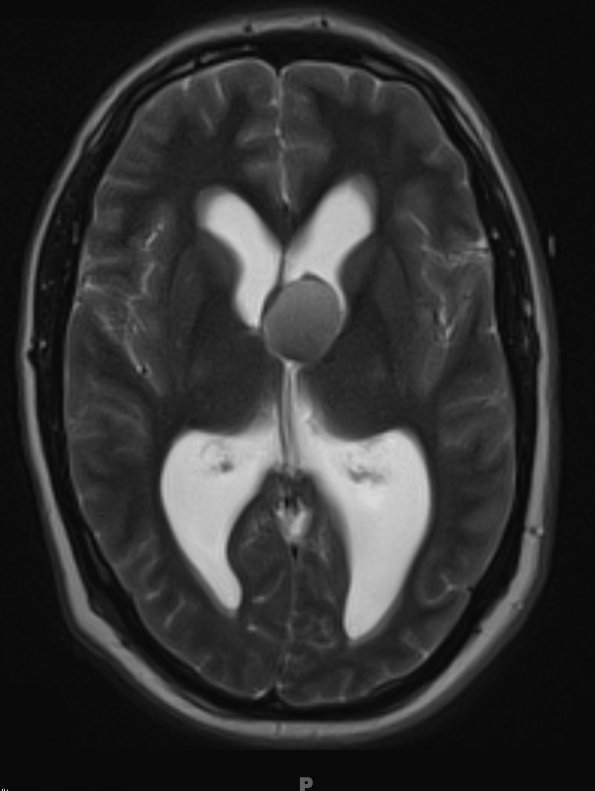 2A6 Cyst, colloid (Case 2) T2 BLADE W