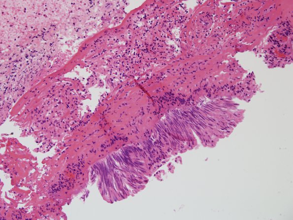 2B1 Cyst, colloid (Case 2) H&E 2.jpg 