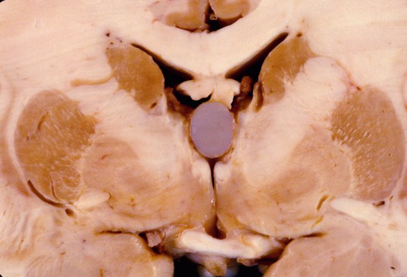 3A2 Cyst, Colloid (Case 3) 1