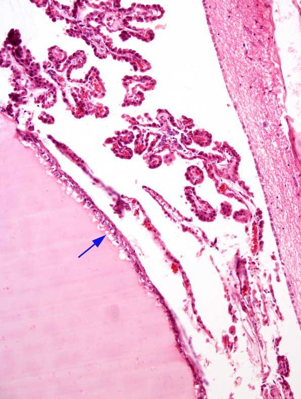 3B2 Cyst, colloid (Case 3) H&E 2.jpg 