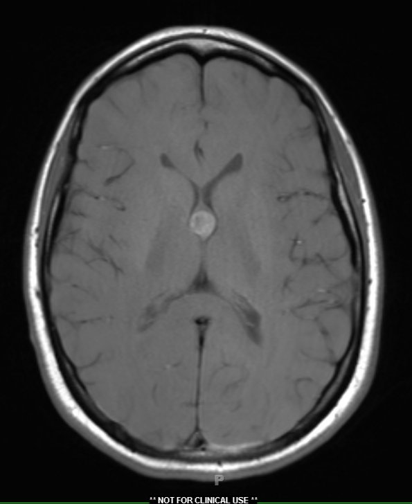 4A1 Cyst, colloid (Case 4) T1 1