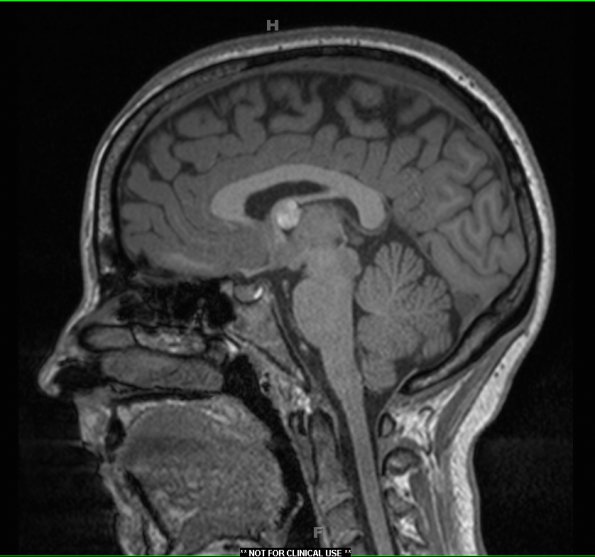 4A2 Cyst, colloid (Case 4) T1 MPRAGE 2