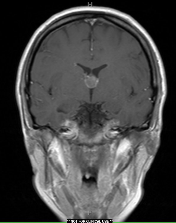 4A3 Cyst, colloid (Case 4) T1 W1