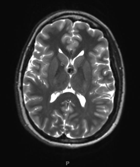 4A4 Cyst, colloid (Case 4) T2 2