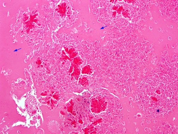 4B2 Cyst, colloid (Case 4) H&E 2