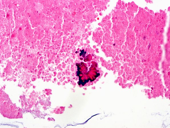 4B4 Cyst, colloid (Case 4) H&E 4