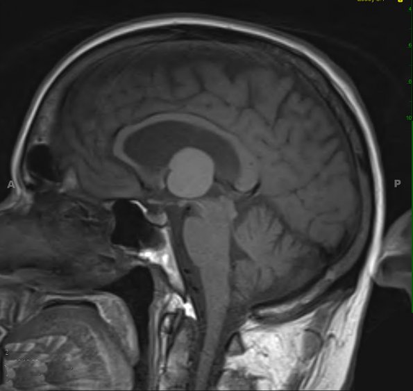 5A1 Cyst, colloid (Case 5) T1