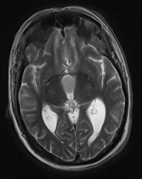 5A3 Cyst, colloid (Case 5) T2 W 2