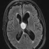 5A4 Cyst, colloid (Case 5) TIRM BLADE