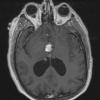 6A1 Cyst, colloid (Case 6) T1