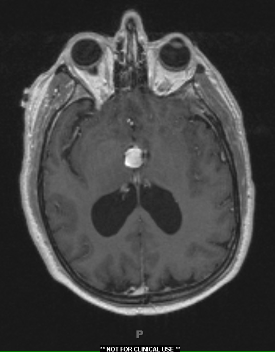 6A1 Cyst, colloid (Case 6) T1