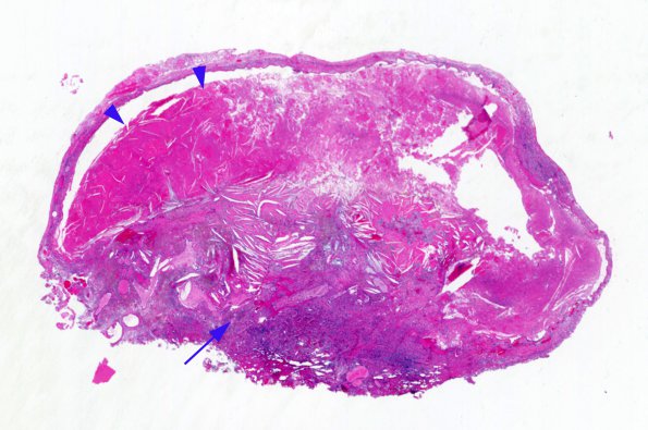 6B1 Cyst, colloid (Case 6) H&E whole mount 2