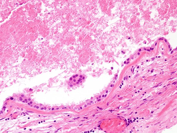 6B3 Cyst, colloid (Case 6) H&E 5