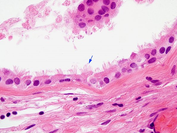 6B4 Cyst, colloid (Case 6) H&E 3