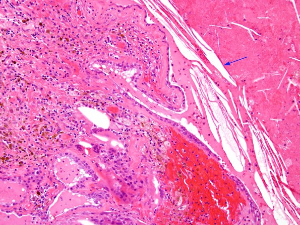 6B5 Cyst, colloid (Case 6) H&E 1