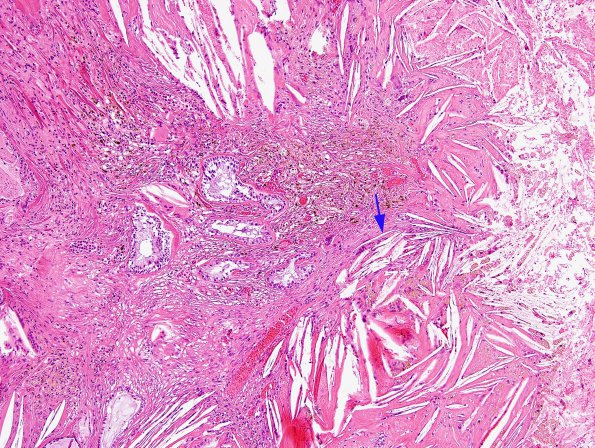 6B6 Cyst, colloid (Case 6) H&E 2