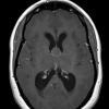 7A1 Cyst, colloid (Case 7) T1 2