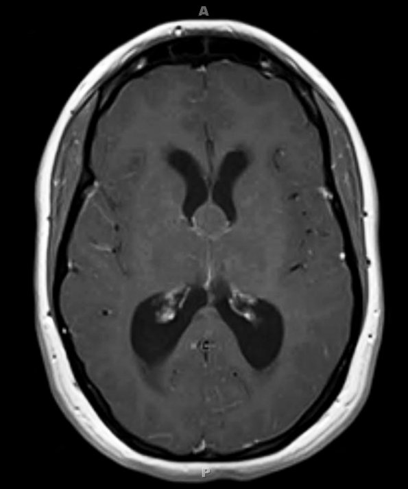 7A1 Cyst, colloid (Case 7) T1 2