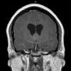 7A2 Cyst, colloid (Case 7) T1