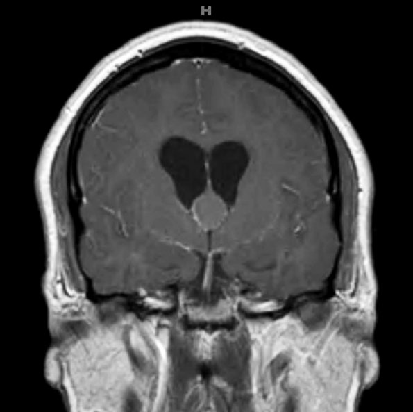 7A2 Cyst, colloid (Case 7) T1