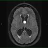 7A3 Cyst, colloid (Case 7) T1 3