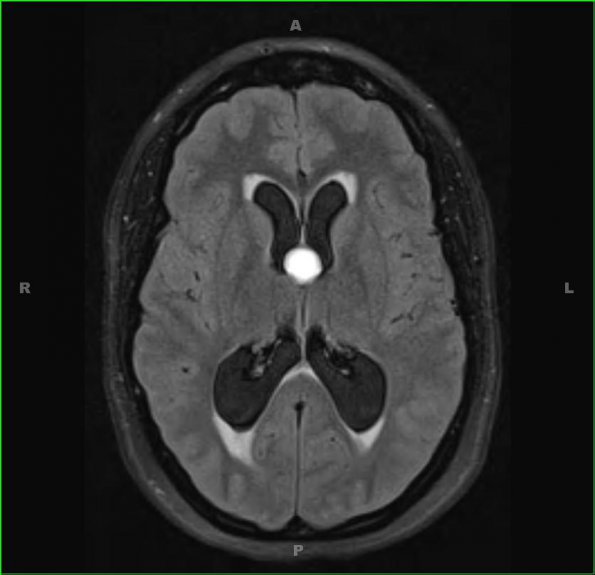 7A3 Cyst, colloid (Case 7) T1 3