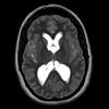 7A4 Cyst, colloid (Case 7) T2