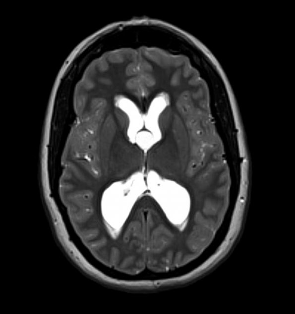 7A4 Cyst, colloid (Case 7) T2