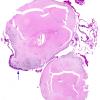 7B1 Cyst, colloid (Case 7) H&E whole mount