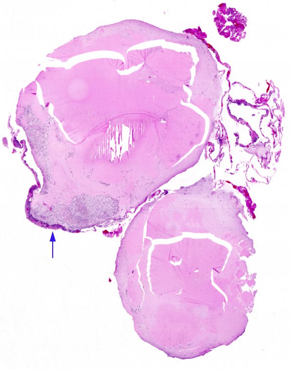 7B1 Cyst, colloid (Case 7) H&E whole mount