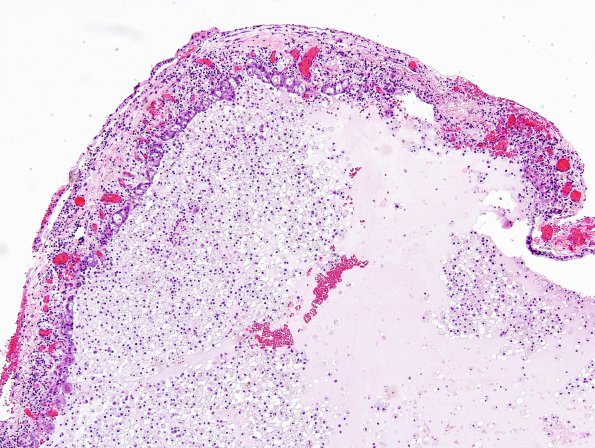 7B2 Cyst, colloid (Case 7) H&E 2