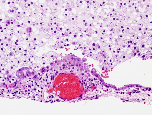 7B3 Cyst, colloid (Case 7) H&E 1