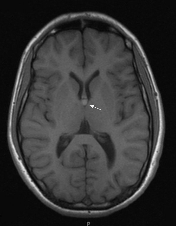 8A1 Cyst, colloid (Case 8) T1