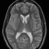 8A2 Cyst, colloid (Case 8) T2 1