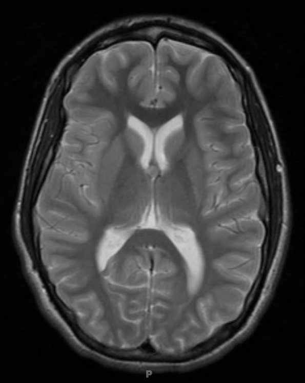 8A2 Cyst, colloid (Case 8) T2 1