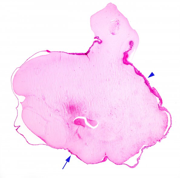 8B1 Cyst, colloid (Case 8) 2X H&E 1