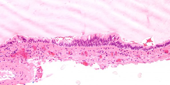 8B2 Cyst, colloid (Case 8) H&E 2