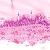 8B3 Cyst, colloid (Case 8) H&E 5