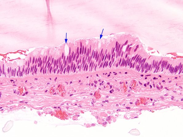 8B3 Cyst, colloid (Case 8) H&E 5