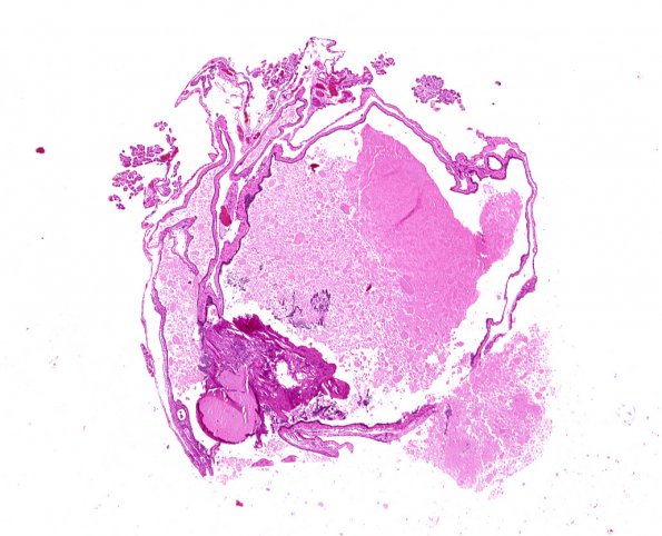 9A1 Cyst, Colloid (Case 9) 3