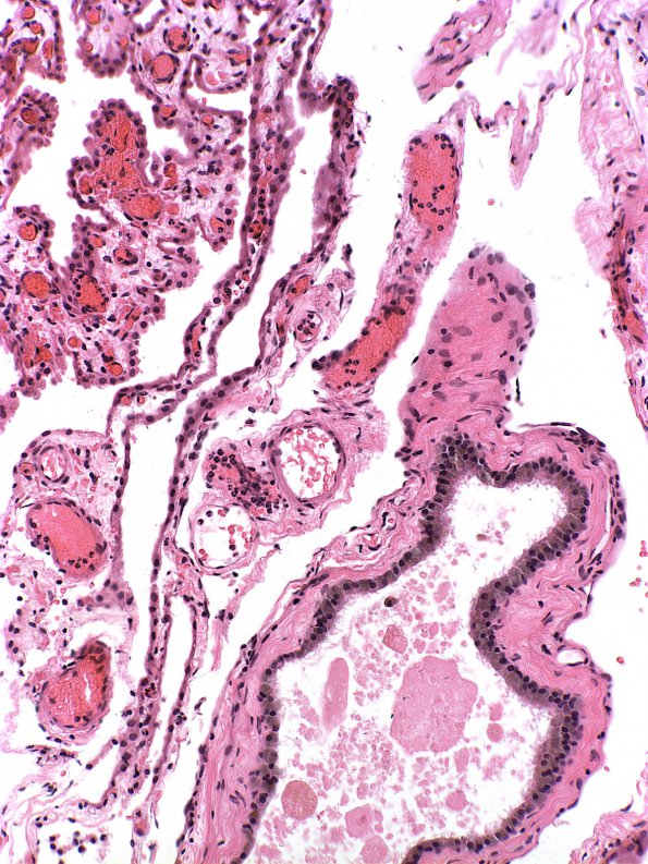 9A2 Cyst, Colloid (Case 9) 4